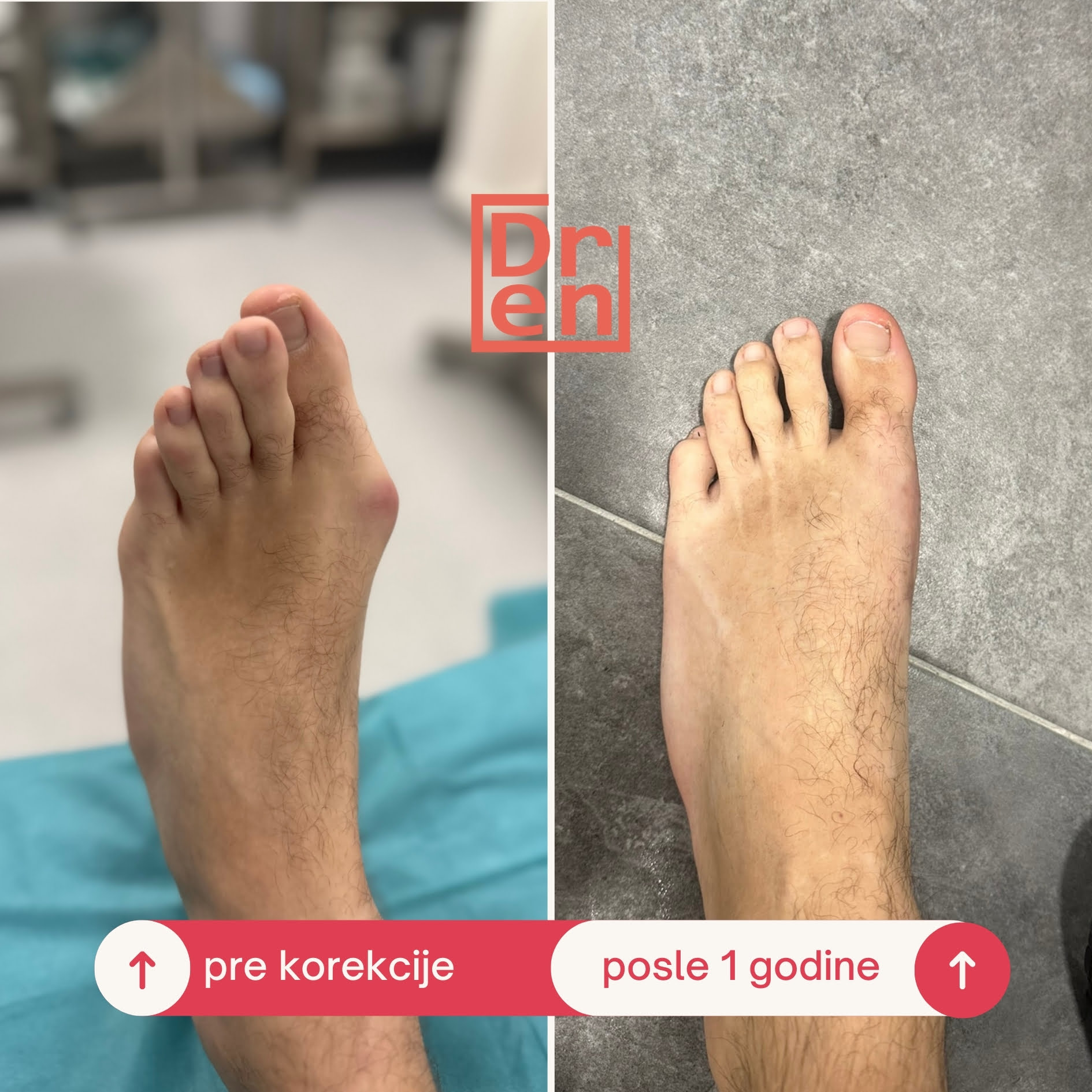 Čukljevi lečenje – operacija čuklja dr Dren dr Radoičić